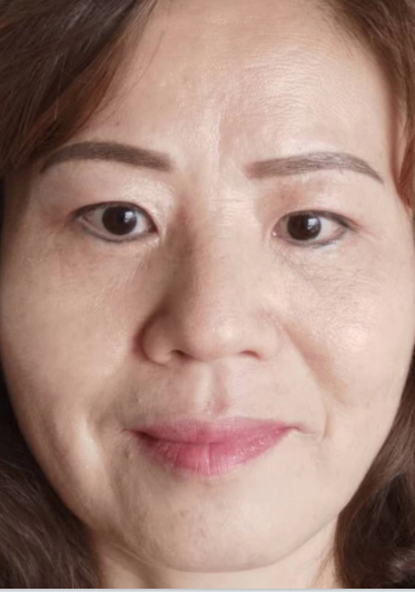 眼袋手术
