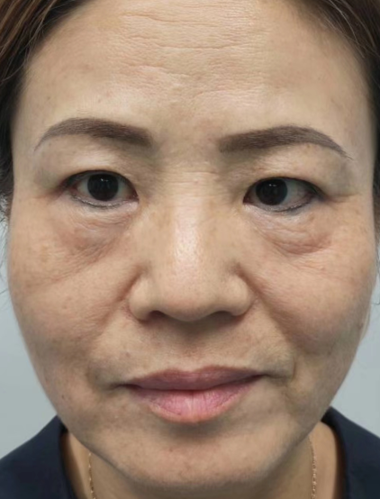 眼袋手术
