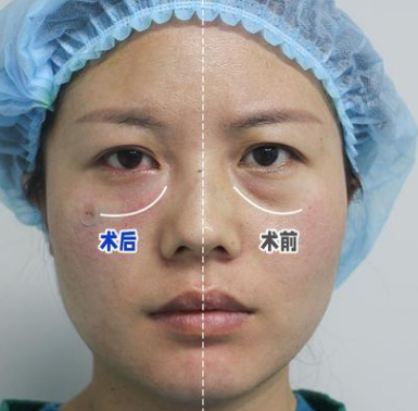 眼袋手术