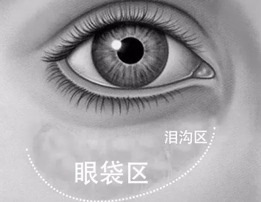 眼袋手术