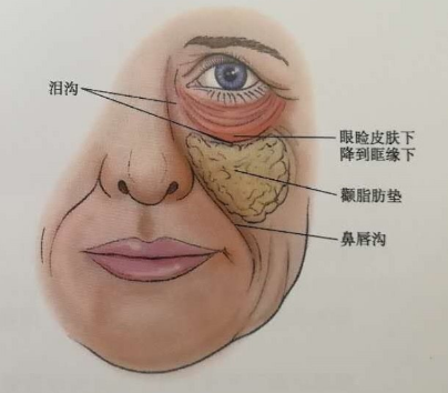 眼袋手术