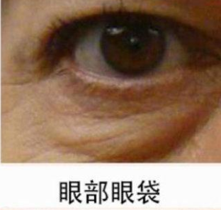 眼袋手术