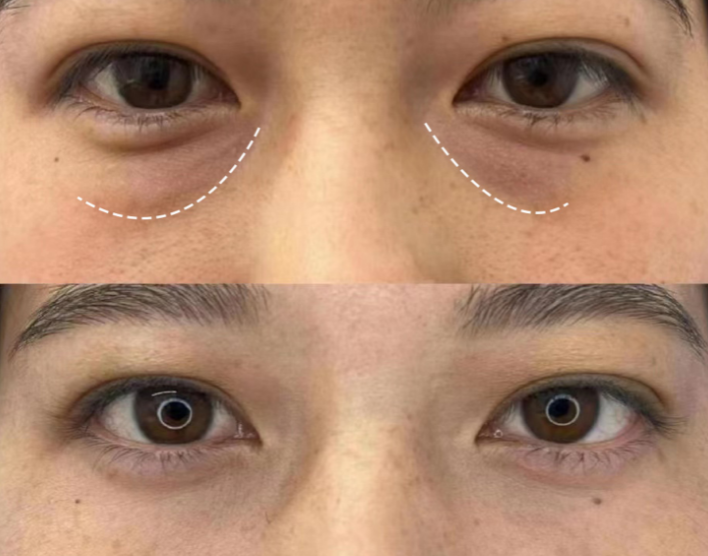 不开刀按摩去眼袋