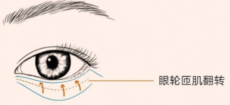 不开刀按摩去眼袋