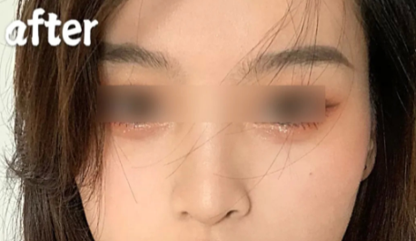 不开刀按摩去眼袋