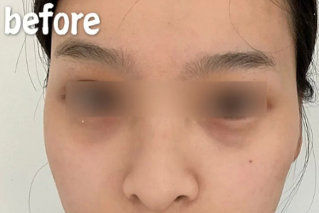 不开刀按摩去眼袋