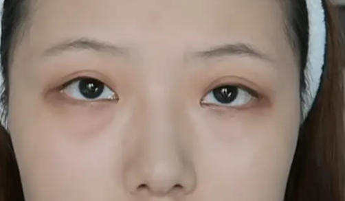 不开刀按摩去眼袋