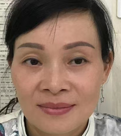 眼袋手术
