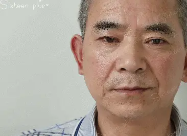 眼袋手术