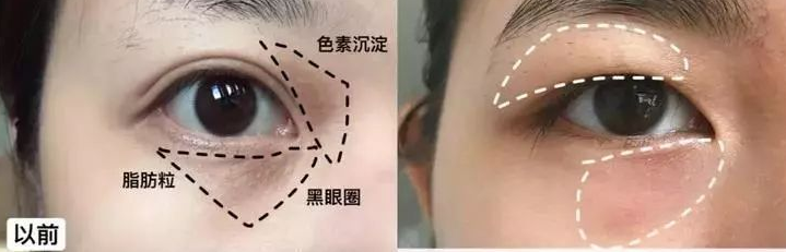 去眼袋手术