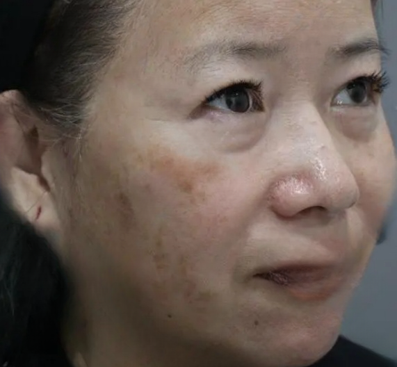去眼袋手术