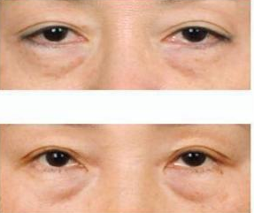 去眼袋手术