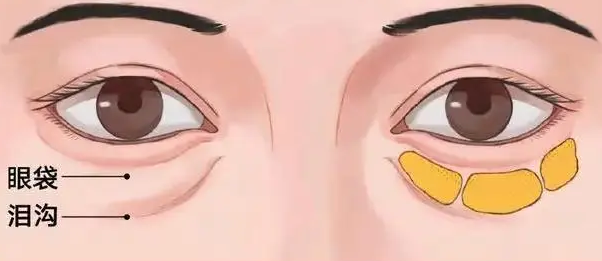 去眼袋手术