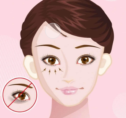 眼袋手术