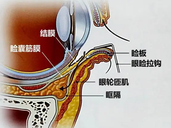 眼袋手术