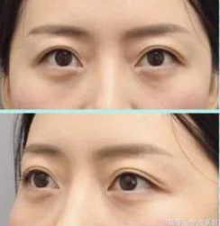 眼袋手术