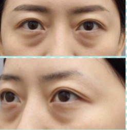 眼袋手术