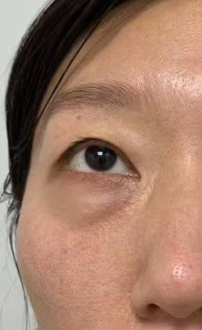 眼袋