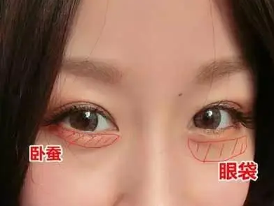 眼袋