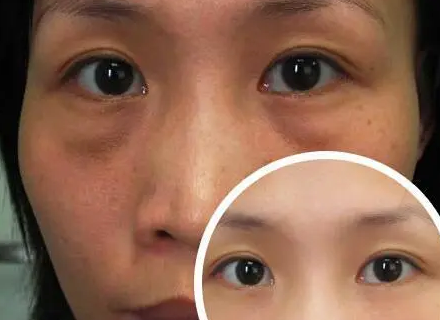 眼袋
