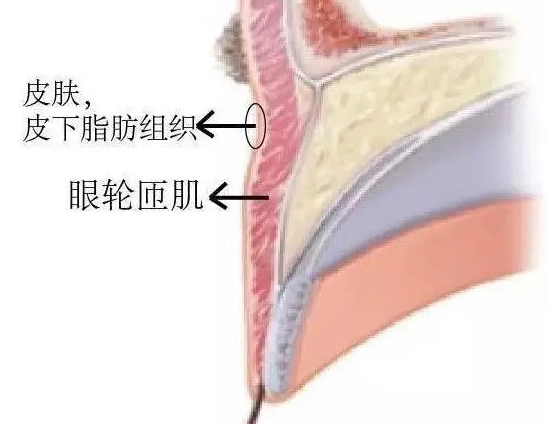 双眼皮手术