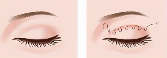 双眼皮