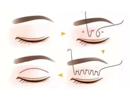 双眼皮