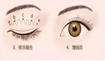 双眼皮