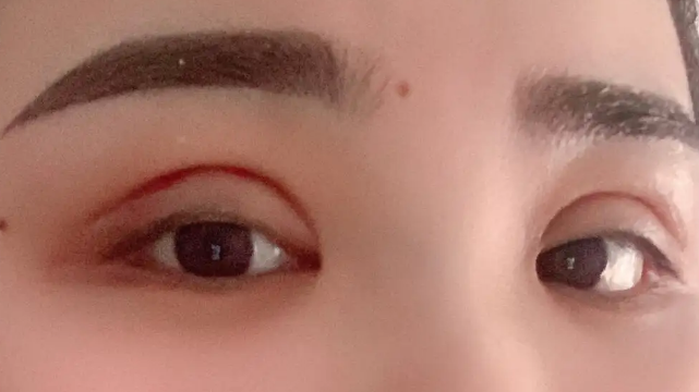 双眼皮