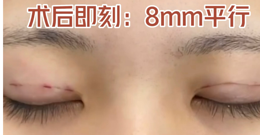 双眼皮