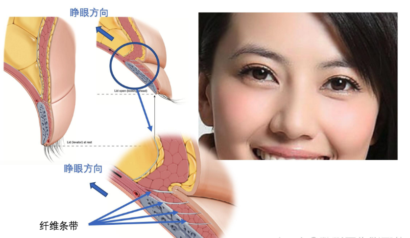 双眼皮手术