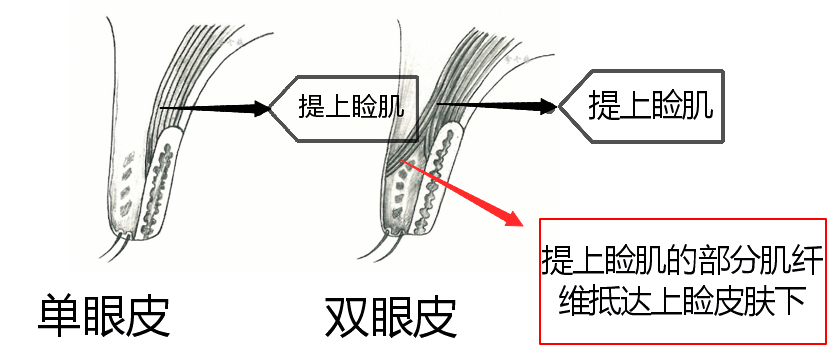 双眼皮手术