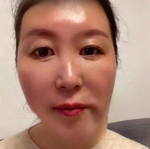 去眼袋手术