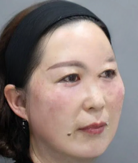 去眼袋手术