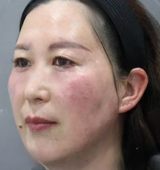 去眼袋手术