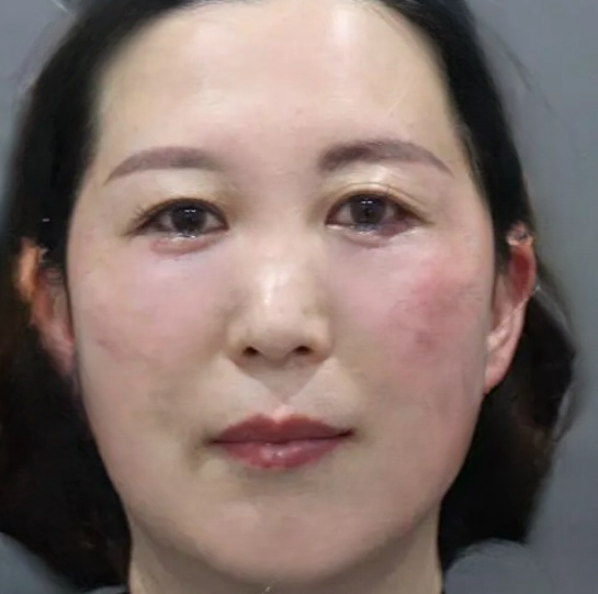 去眼袋手术