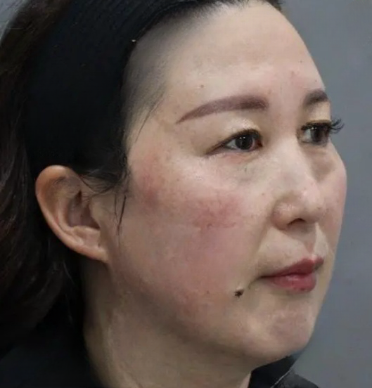 去眼袋手术