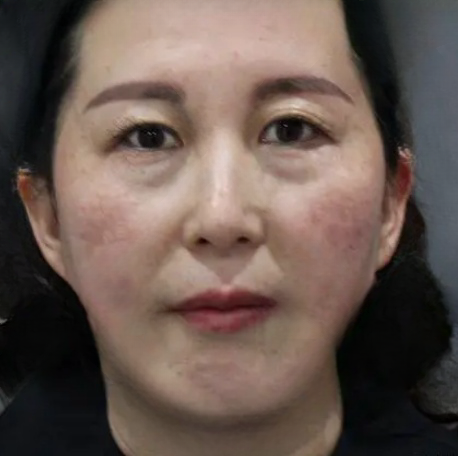 去眼袋手术