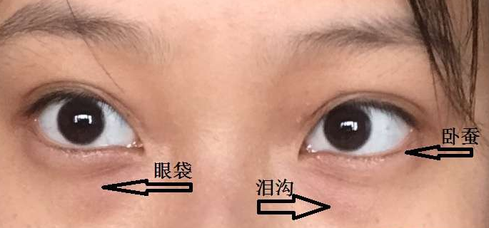 眼袋手术