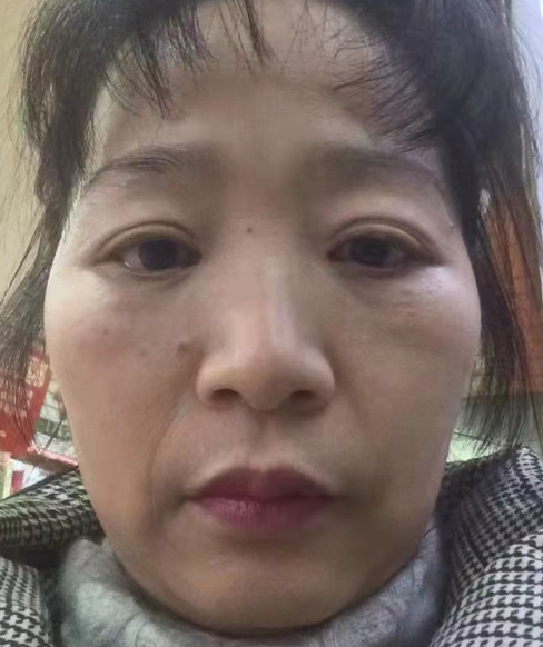 眼袋手术