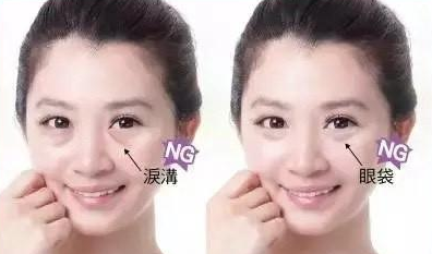 眼袋手术