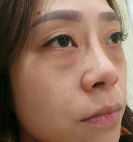 去眼袋手术