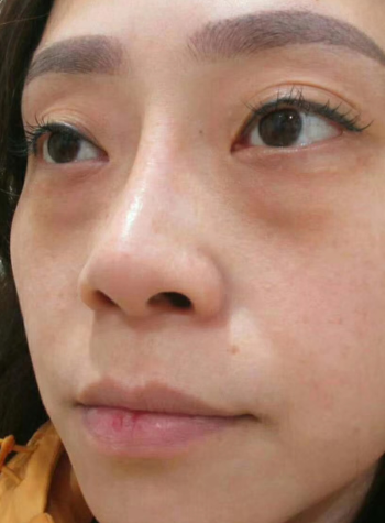 去眼袋手术