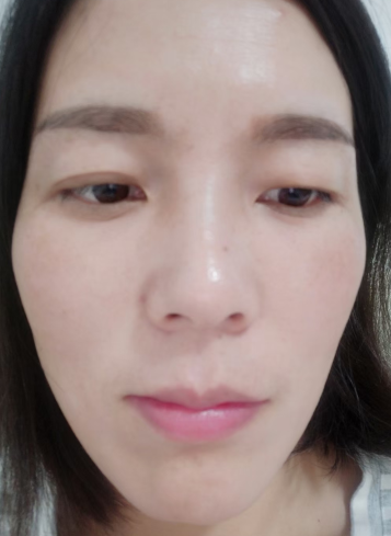 眼袋