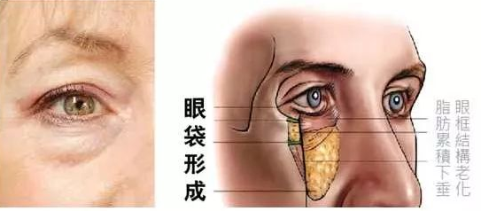 眼袋