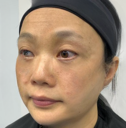 去眼袋手术