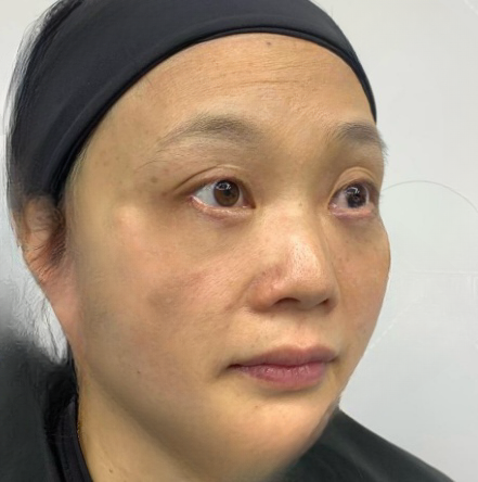 去眼袋手术