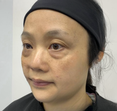 去眼袋手术
