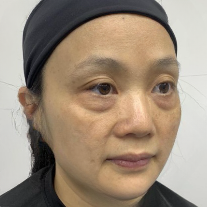 去眼袋手术
