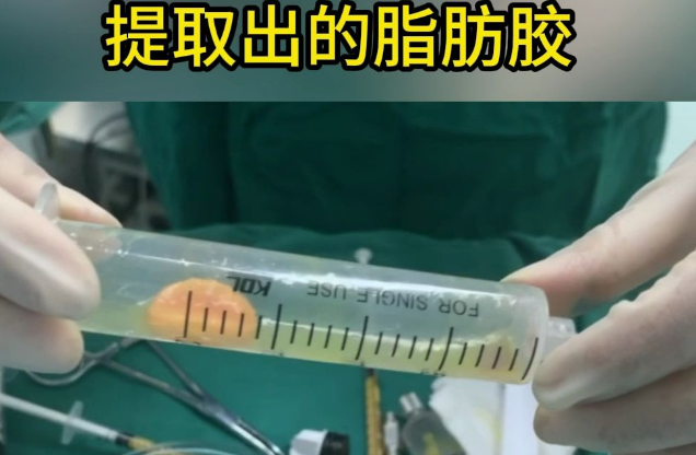 自体脂肪胶